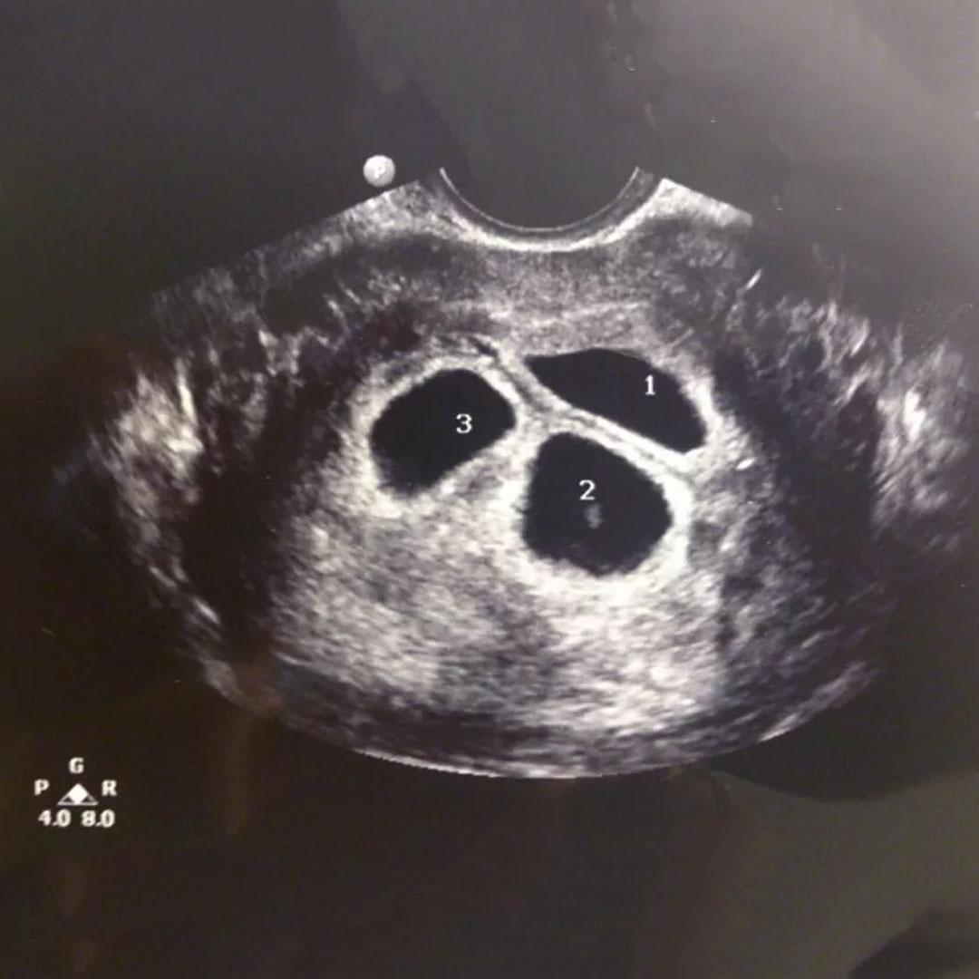 Surgical Sperm Retrieval: Making Parenthood Possible